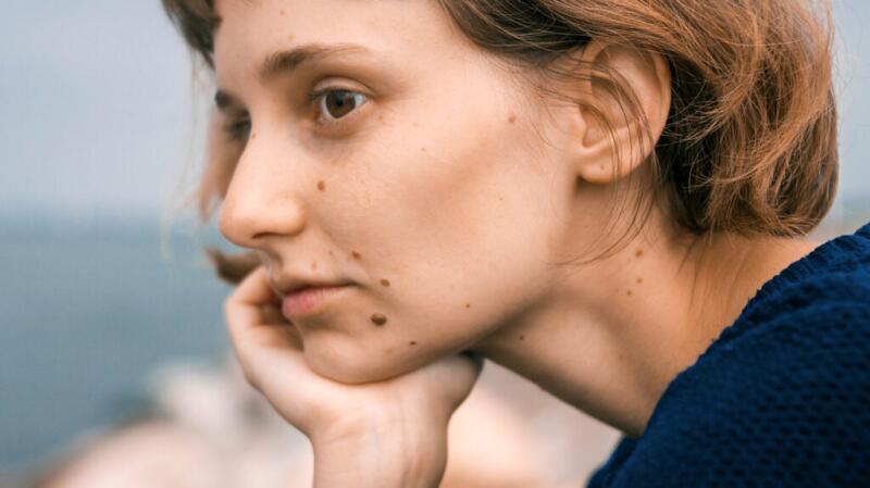 A woman with several moles on her face