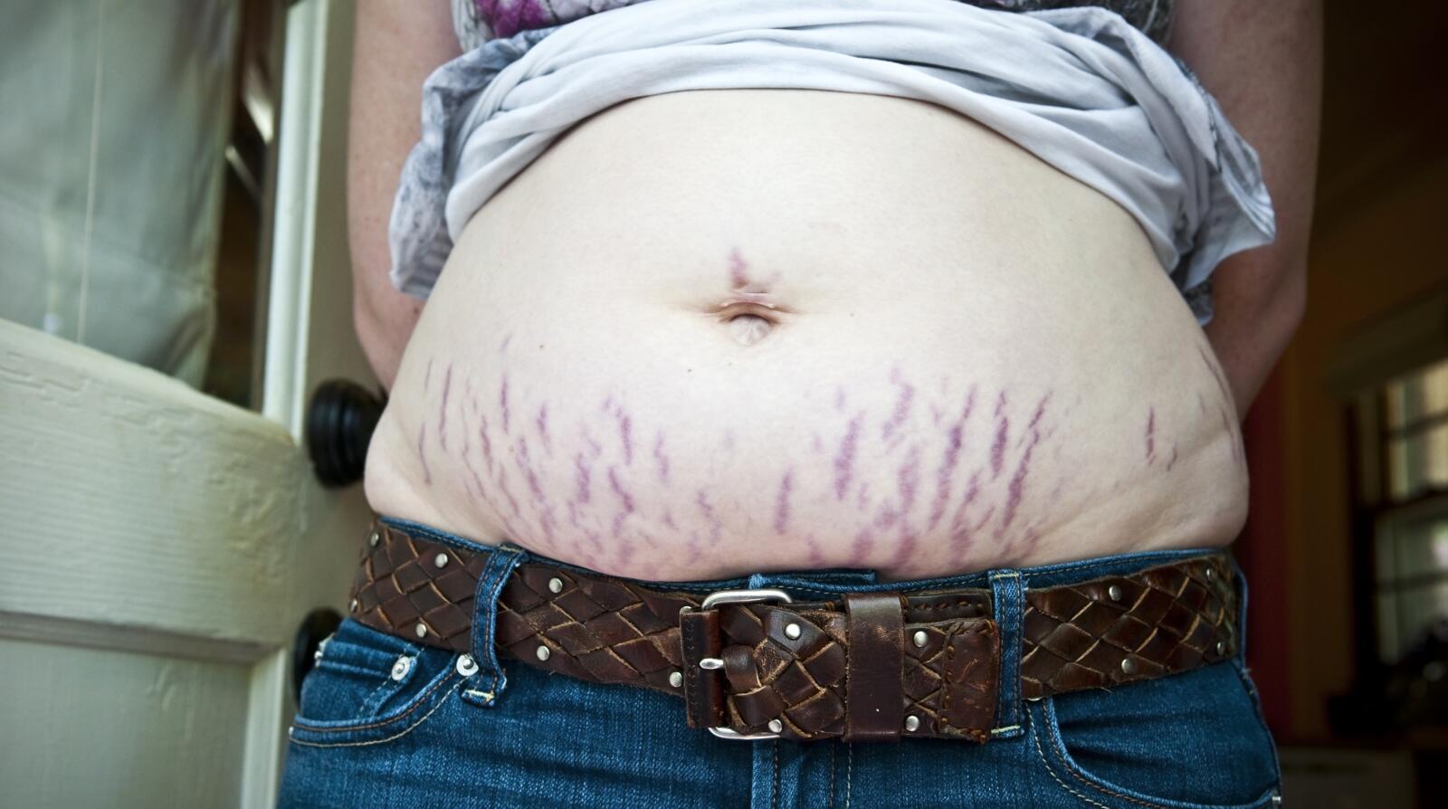 9 Things to Know About Stretch Marks Causes & Treatments