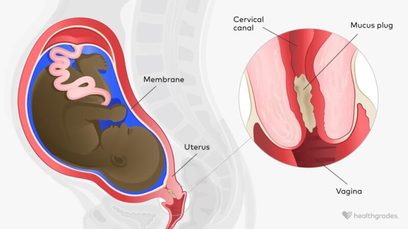 Medical illustration of the mucus plug in the cervix during pregnancy