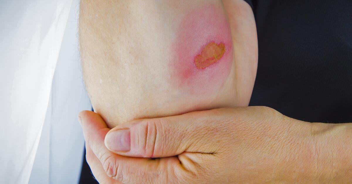 Frequently Asked Questions About Burns | How To Treat & Heal Burns