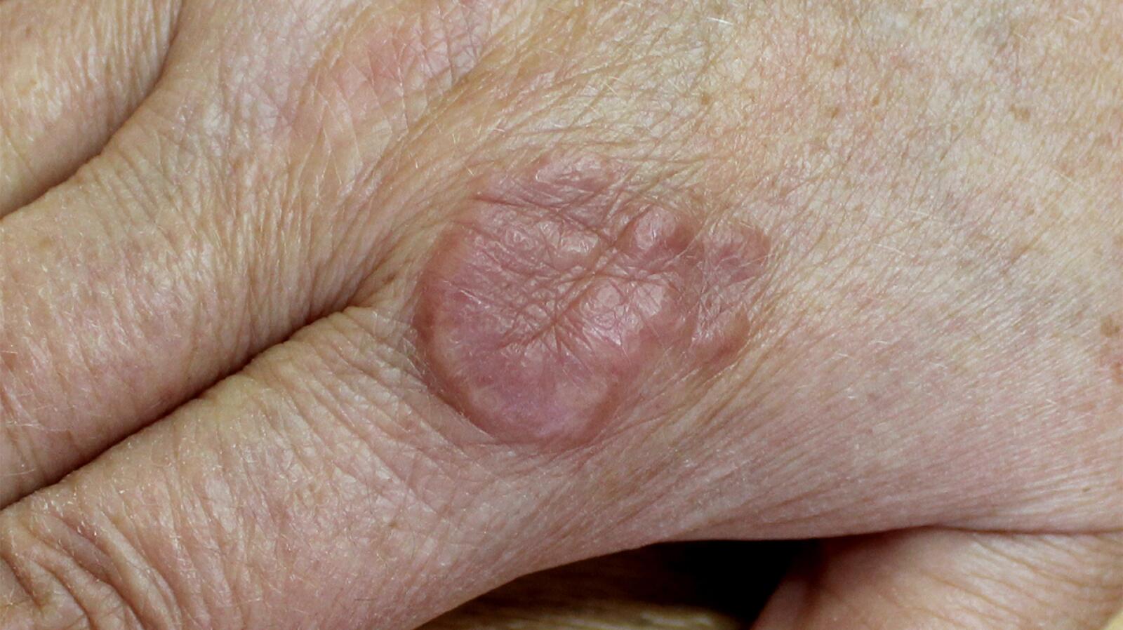 Granuloma Annulare: Symptoms, Causes, Diagnosis, and Treatments