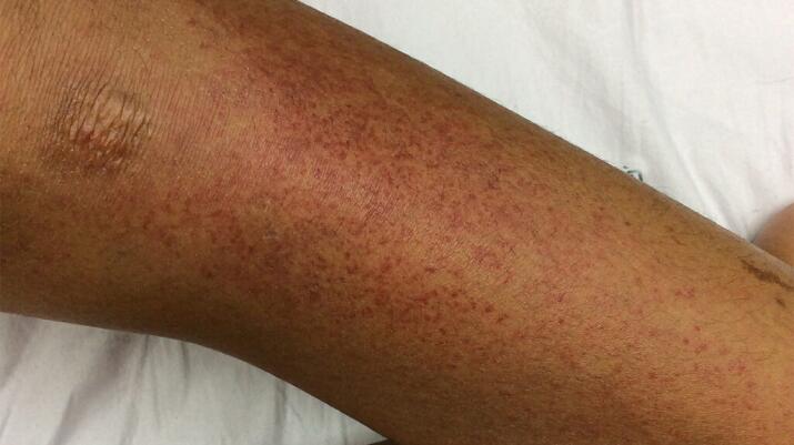 Peteque Rash Petechiae (Bleeding into the Skin): Causes, Treatments, and More