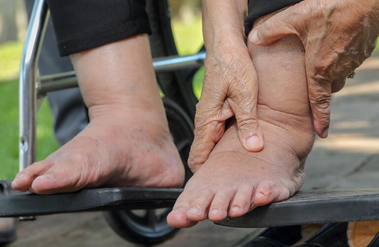 Close-up of unseen woman's feet in wheelchair with lymphedema