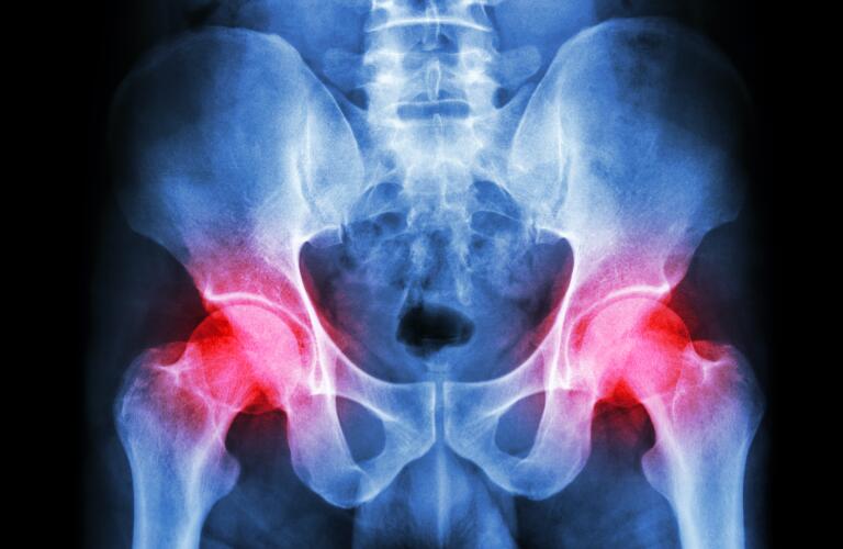 hip-joint-pain-illustrated-on-x-ray