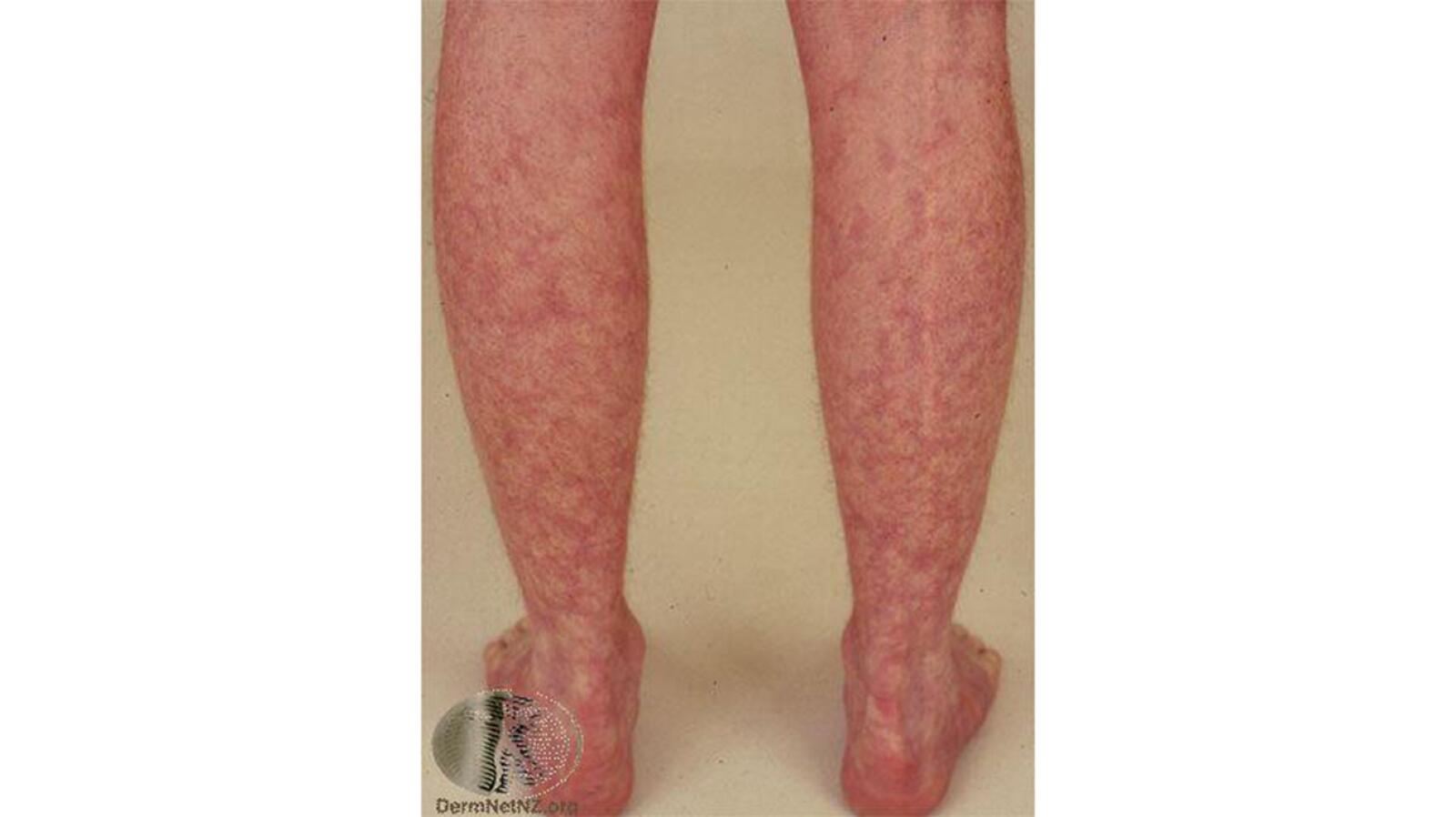 Mottled Skin (Livedo Reticularis): Causes Signs and Treatment
