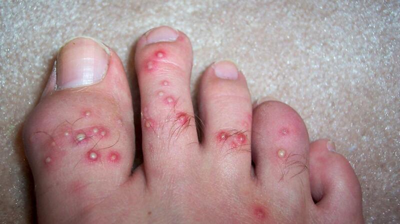 ?url=https%3A%2F%2Fucmscdn.healthgrades.com%2Fa9%2F72%2Fe7461bcf67c8ba1bf148575bd7fe%2Ffire ant fire ant bites bug bites ant bite insect bite body1 Are U Supposed to Pop Ant Bites