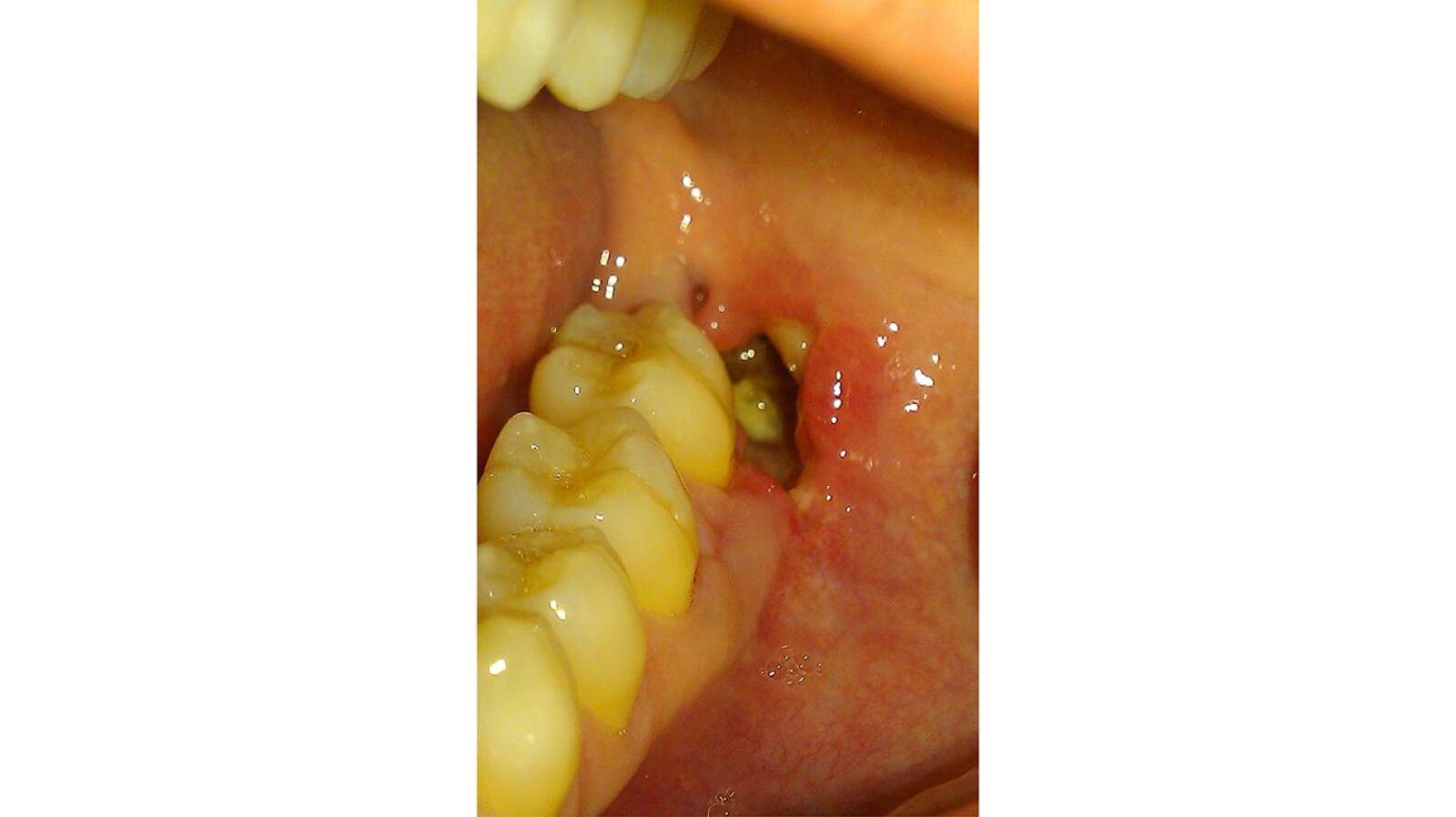 Dry Socket Causes, Symptoms, Treatment, and More