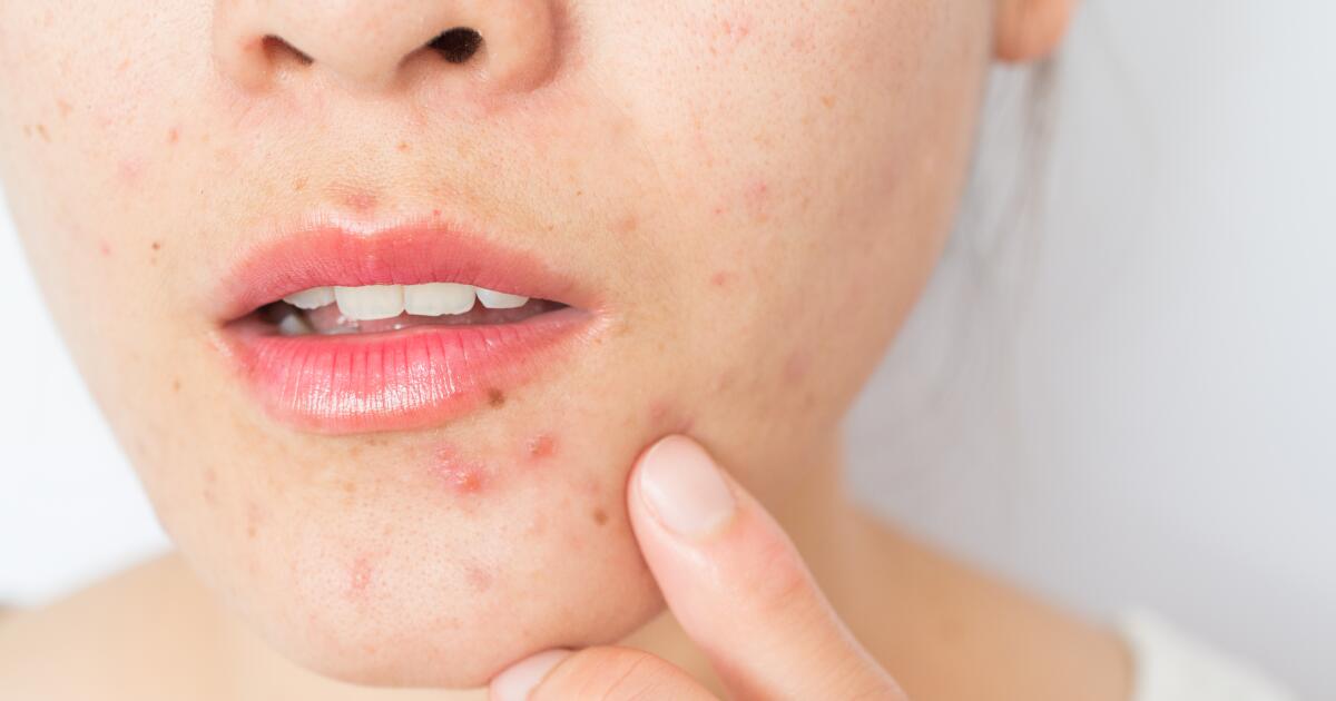 Boil Vs Pimple How To Tell The Difference