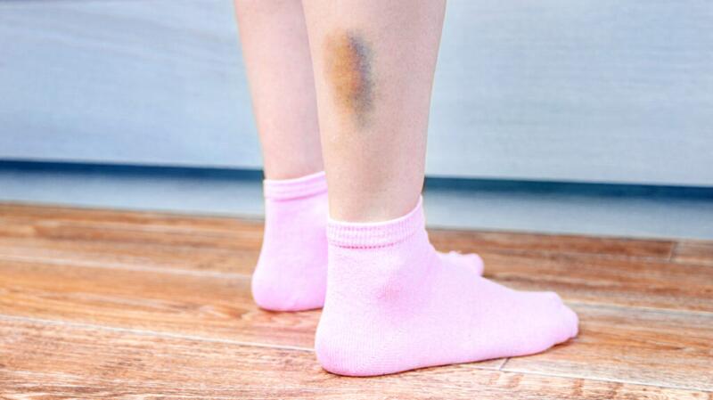 bruise on a leg with pink socks