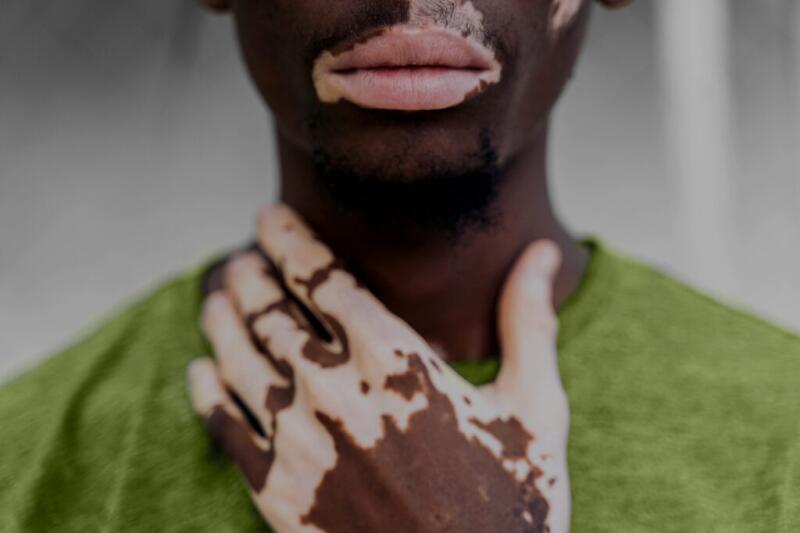 Person with white patches on hands and face