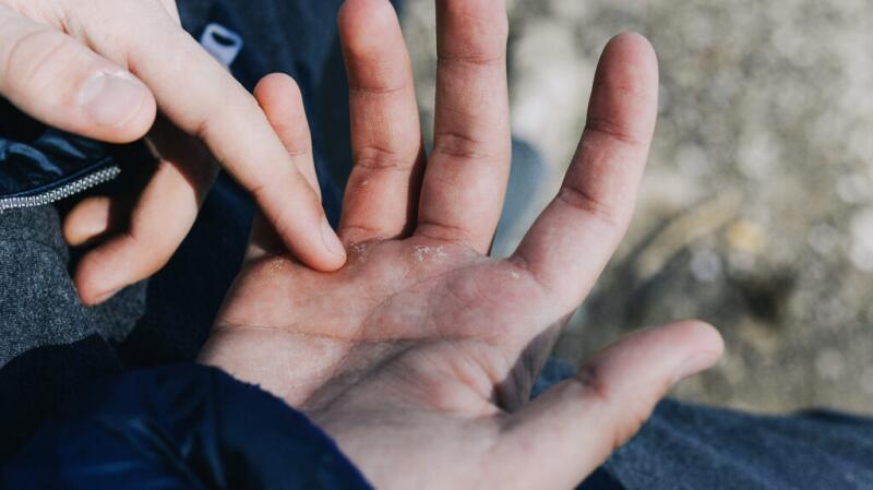 There is a hand with skin lesions.