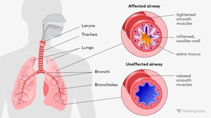 An illustration showing the physiological changes that occur in the airways during an asthma attack