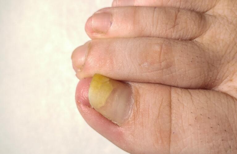 Toenail Problems Fungus, Thickening & Yellow Toenails