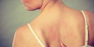 woman pointing at skin rash on back