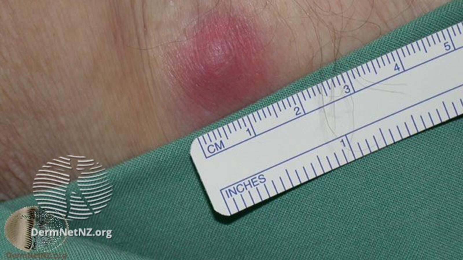 Boil Causes, Symptoms, Treatments, and More