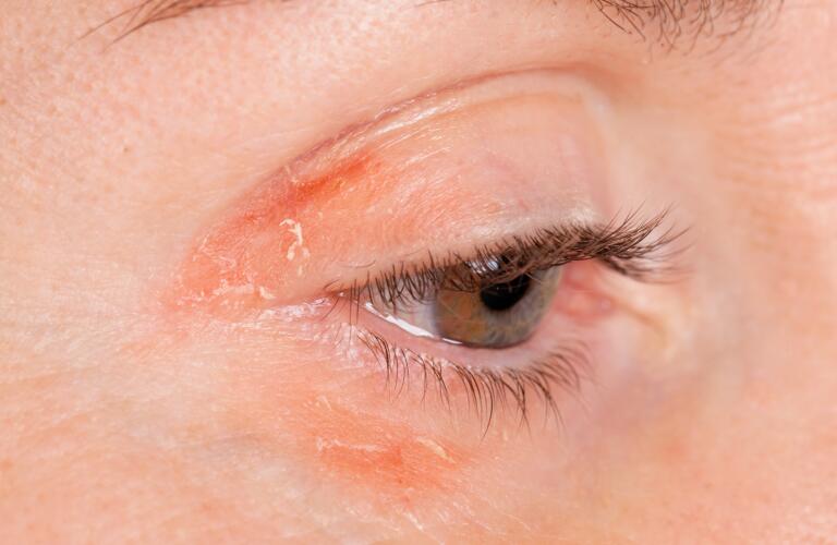 closeup of woman's eye with psoriasis