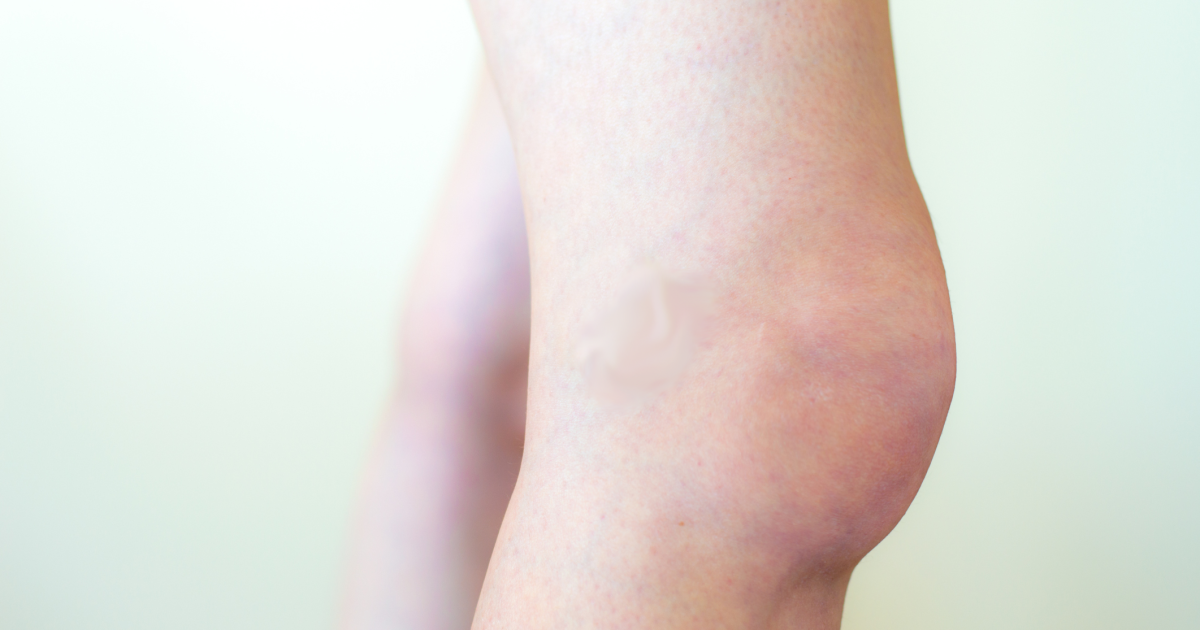 Knee Swelling - Symptoms, Causes, Treatments