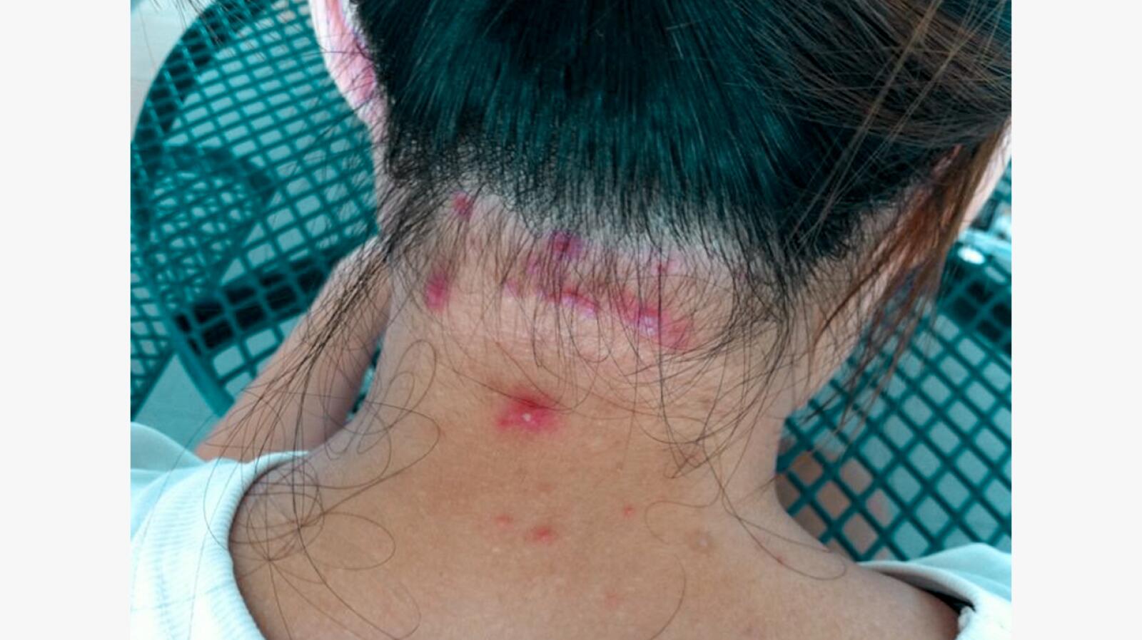Hair Rash Scalp Folliculitis: Signs, Causes, Treatment, and More