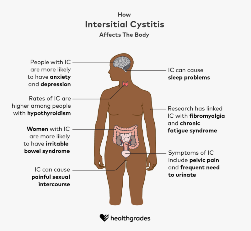Infographic showing how interstitial cystitis affects the body