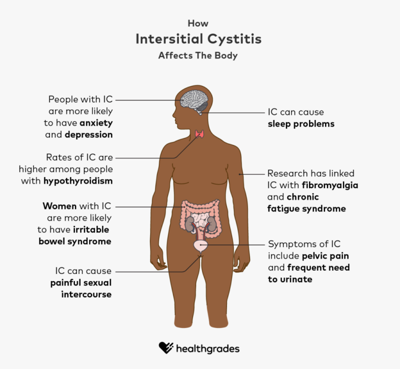 What is Interstitial Cystitis(IC)/Bladder Pain Syndrome? - Urology