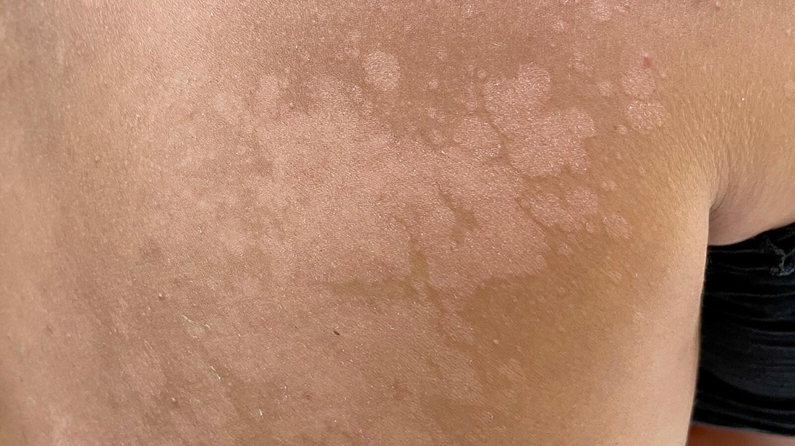 Tinea Versicolor Symptoms Causes And Treatment tinea-versicolor-symptoms-causes-and-treatment