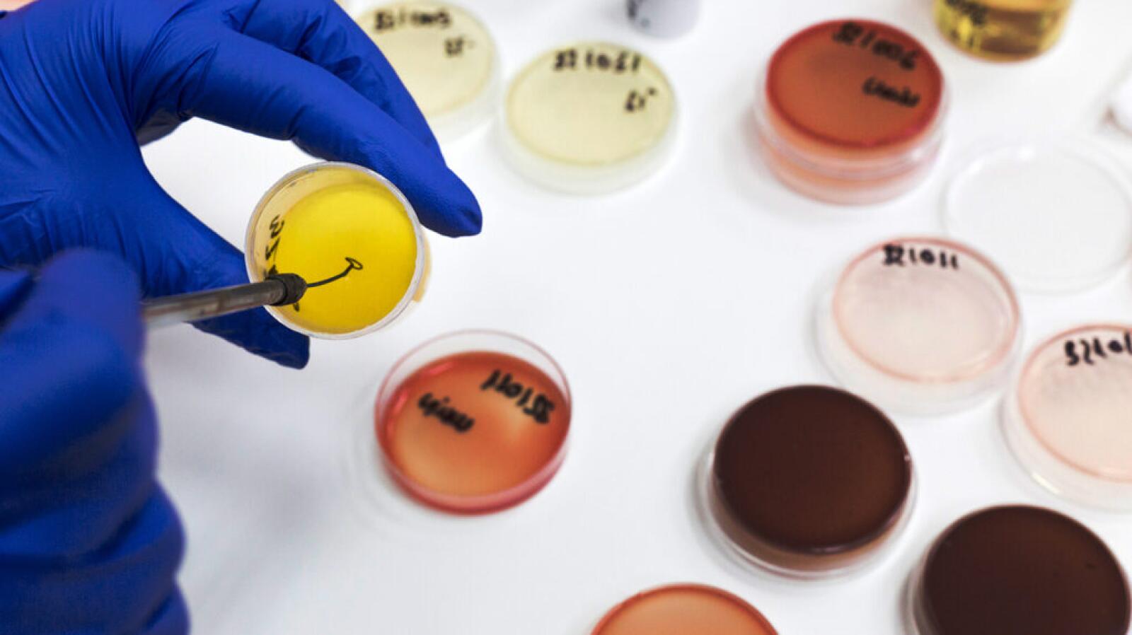 Proteinuria: Causes of Protein in Urine, Symptoms, and More