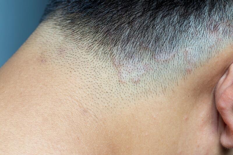Bumps on the Scalp: Pictures, Causes, Treatments