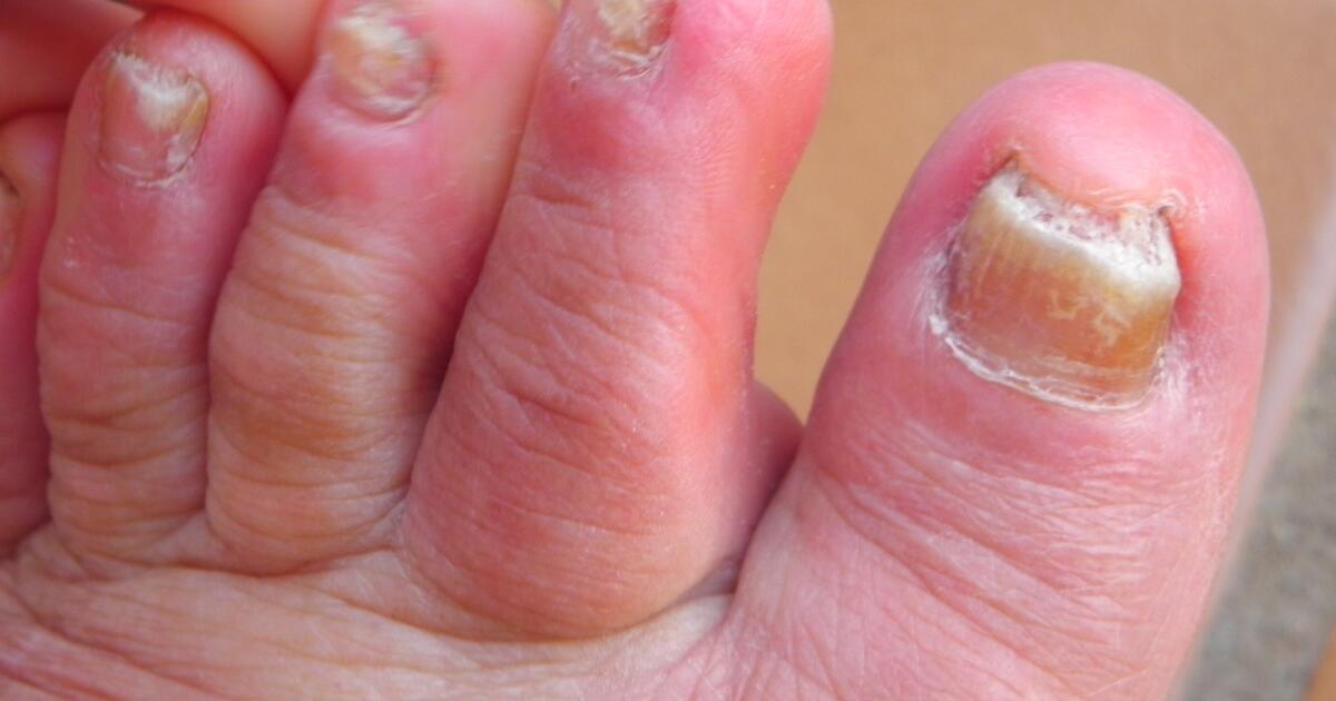 THE FASTEST WAY TO TREAT TOENAIL FUNGUS?! - YouTube