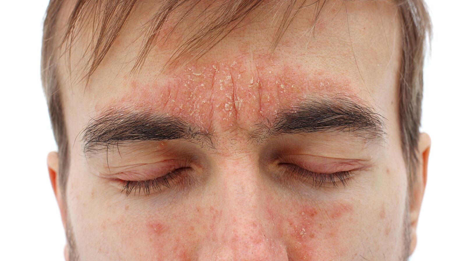 Eyelid Dermatitis Treatments Symptoms Causes And More 