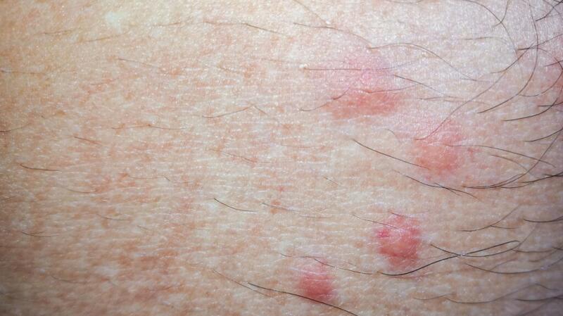 7 Causes of Red Spots and Bumps on Skin, With Pictures