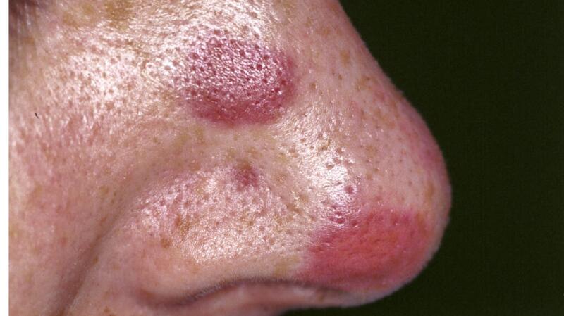 Purple patches on the nose due to Kaposi's sarcoma.