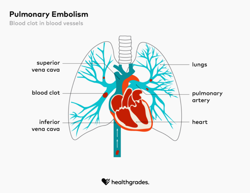 pulmonary embolism diagram