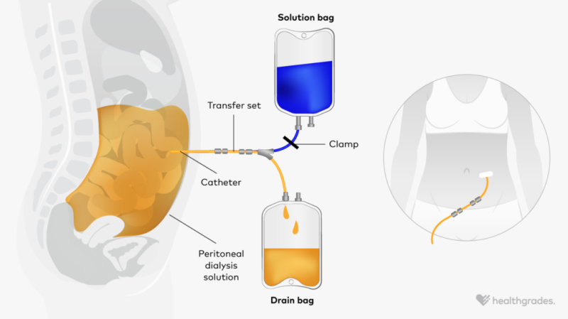Peritoneal dialysis removes waste products from your blood.