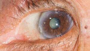 White Eye Sign White Spot on Eye: Causes, Treatments, and Prevention