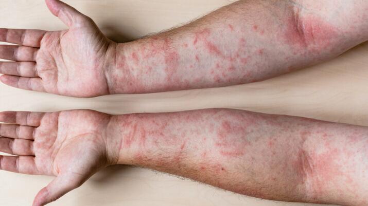 Red Spots On Skin Causes And Treatment