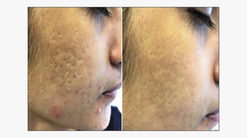Subcision Skin Changes Subcision: What Is It, Does It Work, and Will It Help You?