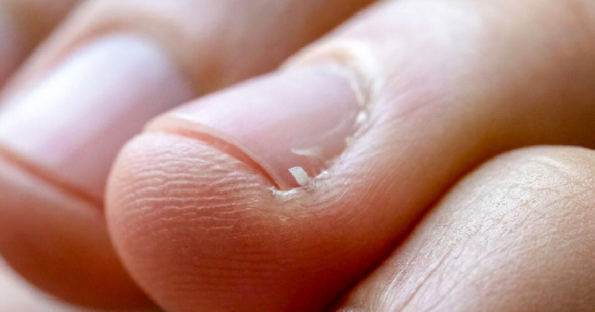 Hangnail: Causes, Symptoms, And Treatment