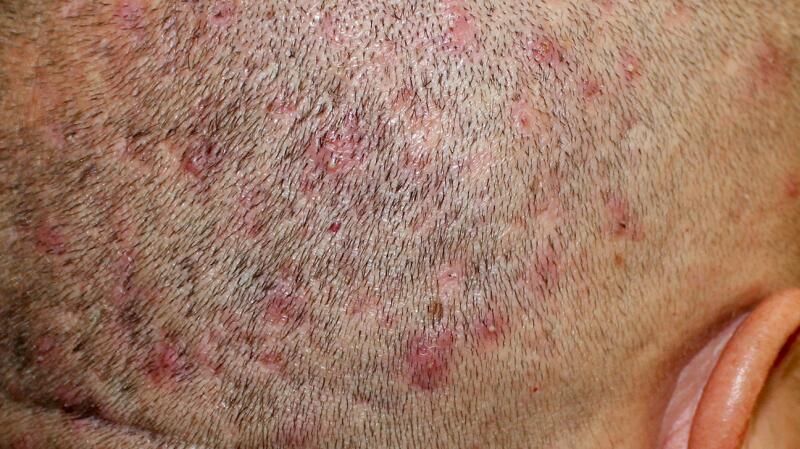 Scalp Folliculitis Signs Causes Treatment And More 