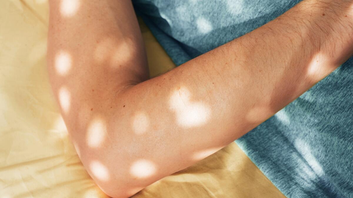 dermatitis herpetiformis elbow
