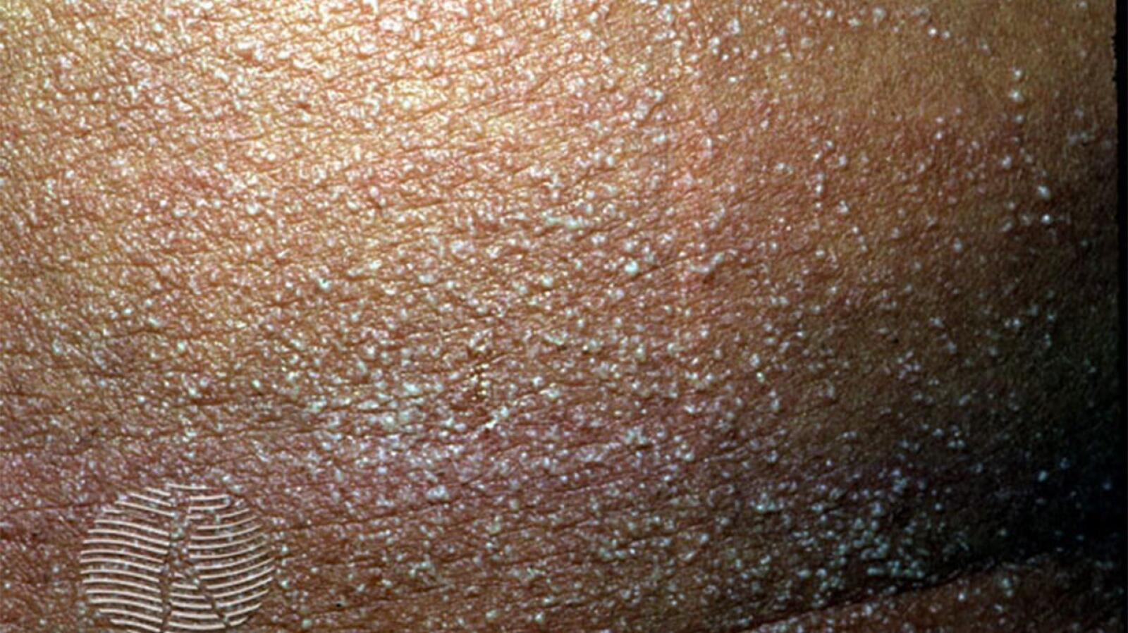 Rash on Stomach: Causes, Symptoms, and Treatment