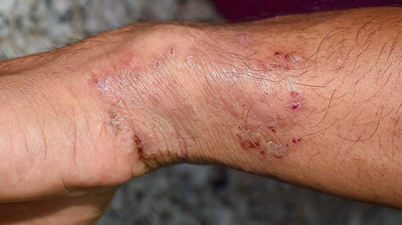 Tinea Manuum Skin Disease Close Foto stock 244876210