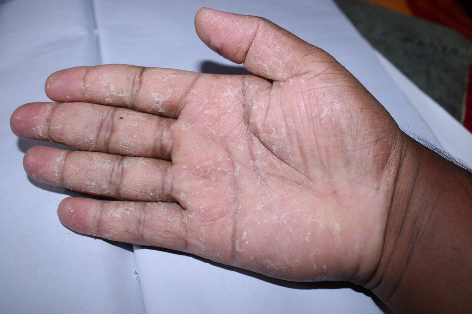 Rash on Hands: Symptoms, Treatments, Causes, and More