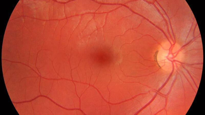 Diabetic Retinopathy Microaneurysms Symptoms And Treatment Diabetic Retinopathy Microaneurysms Symptoms And Treatment