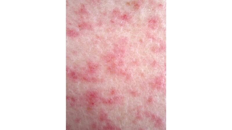 bright pink spots on skin