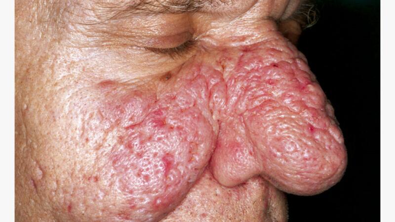 A close-up photo of a man with phymatous rosacea