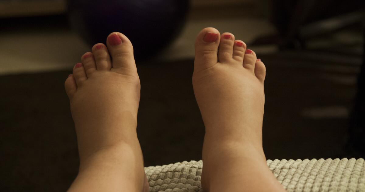 When To See A Doctor For Swollen Feet Treatment