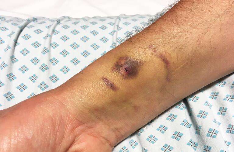 hematoma and bruising on patient's lower arm after surgery