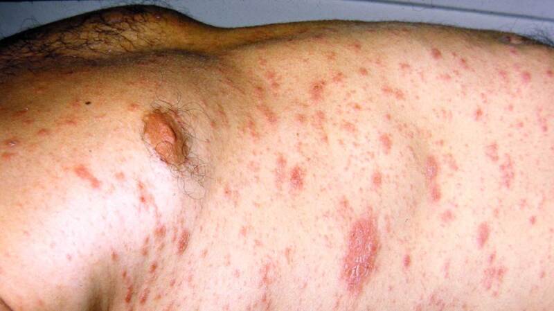 Back Rash Infection Rash on Back: Causes Treatments, Symptoms, and More