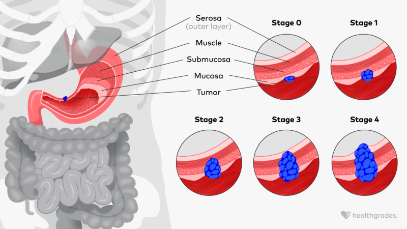 An illustration of the growth of a stomach tumor