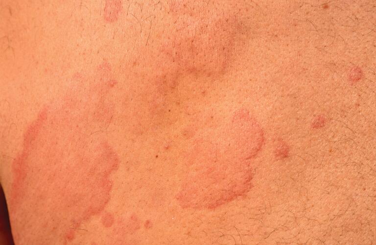 closeup of hives reaction on skin